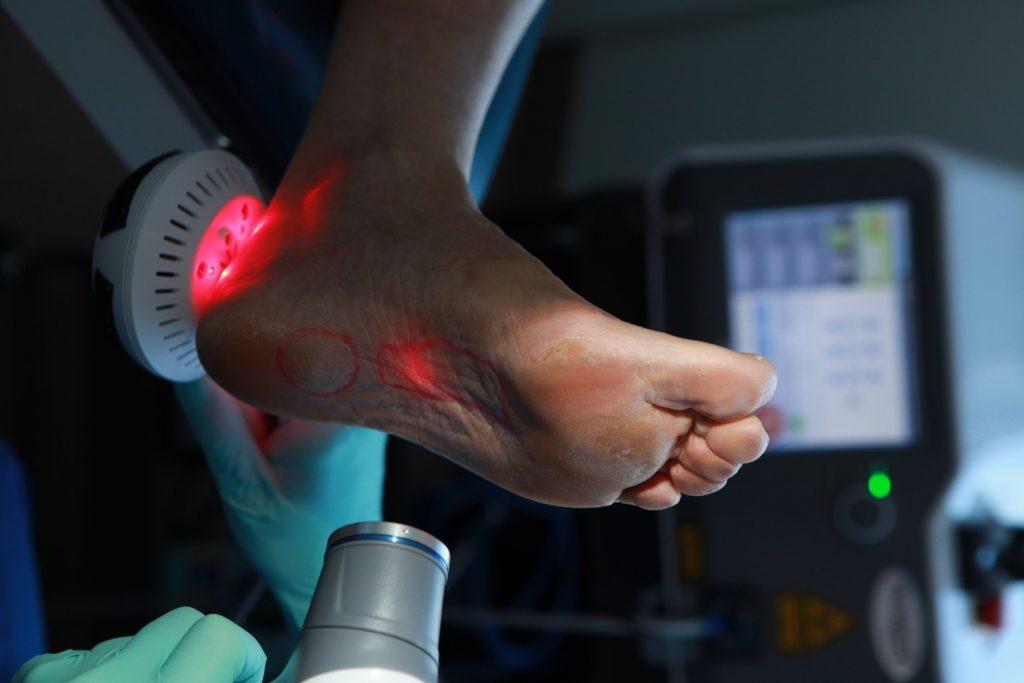 Laser Foot Therapy